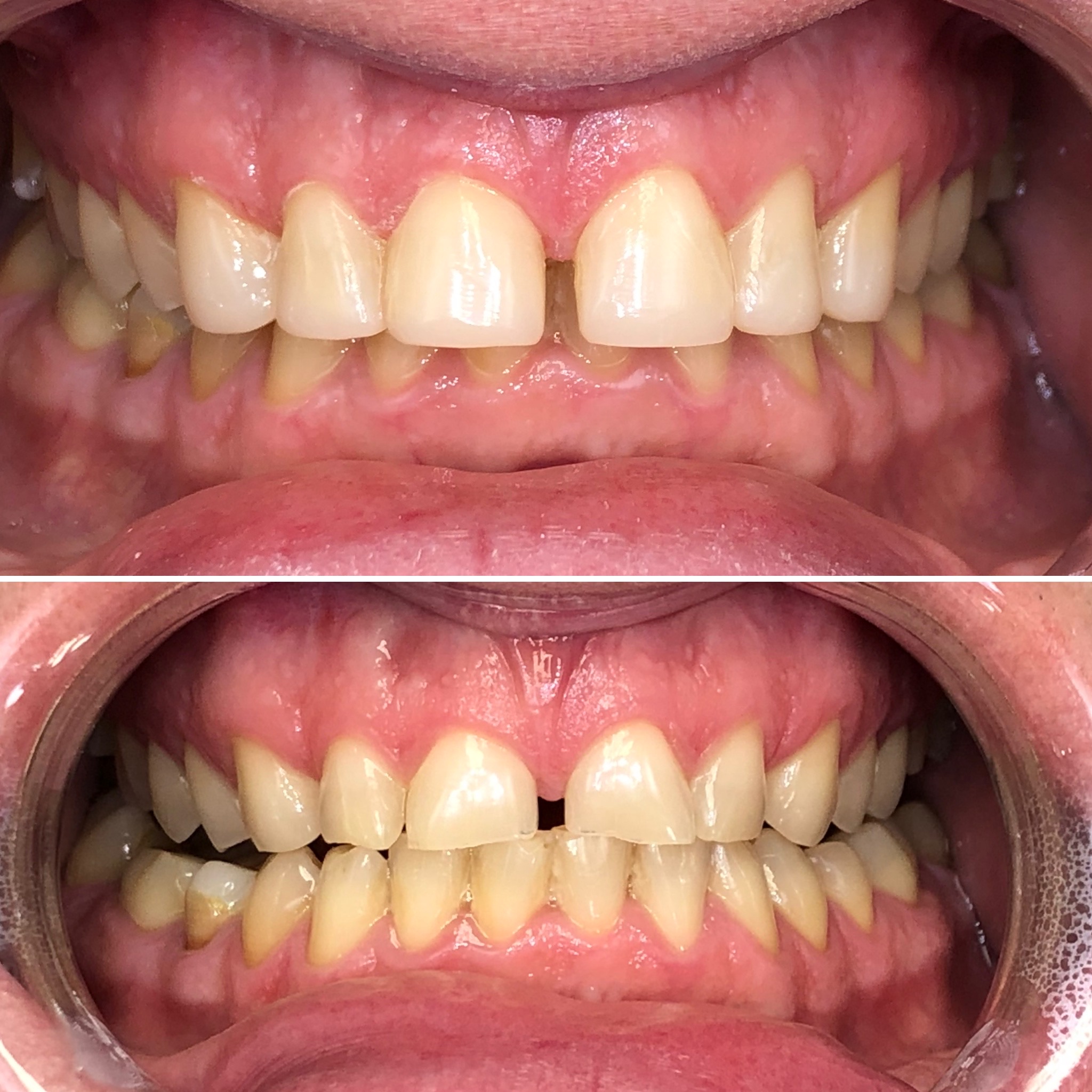 Bonding górnych zębów