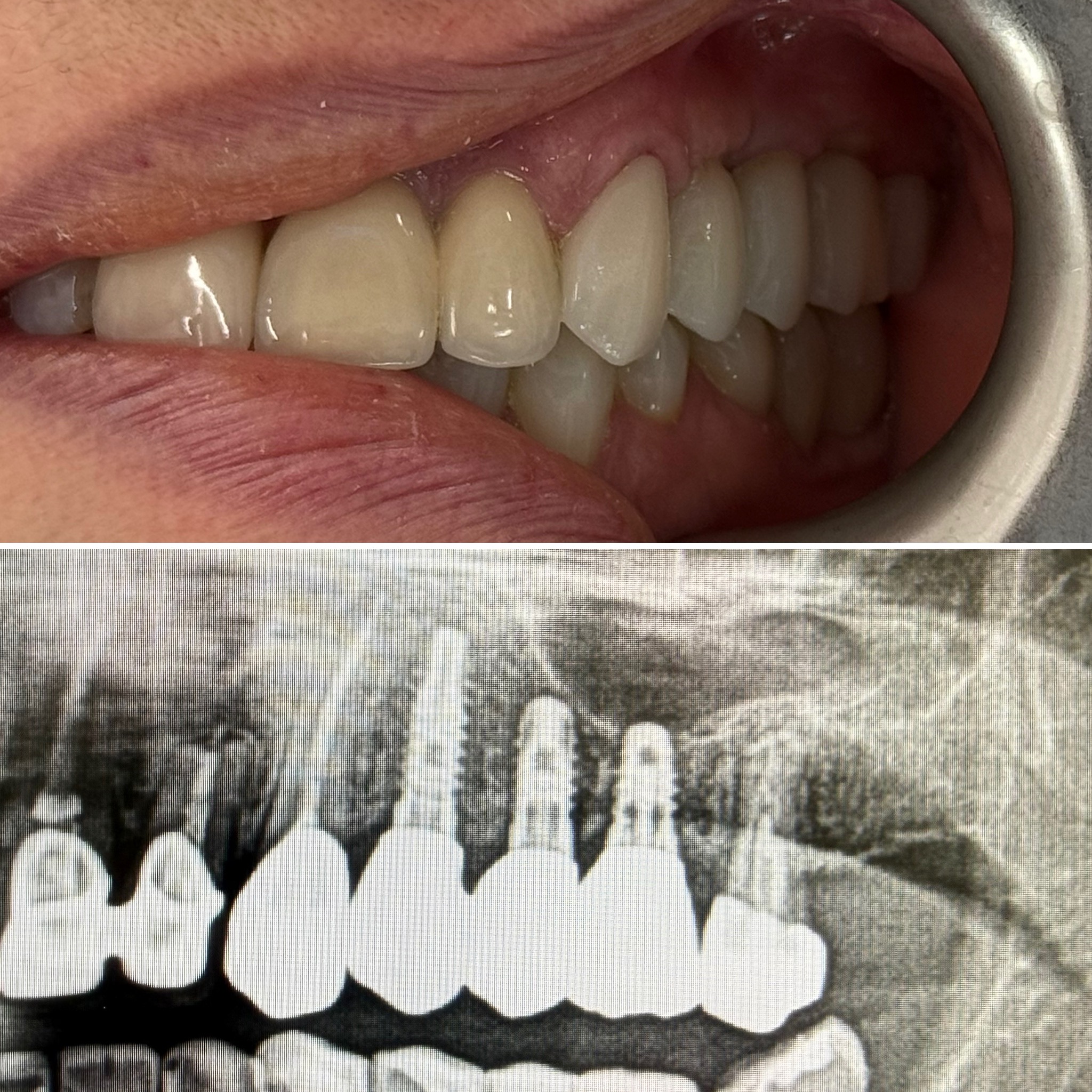 Korony cyrkonowe na implantach okolicy górnej lewej 4,5,6