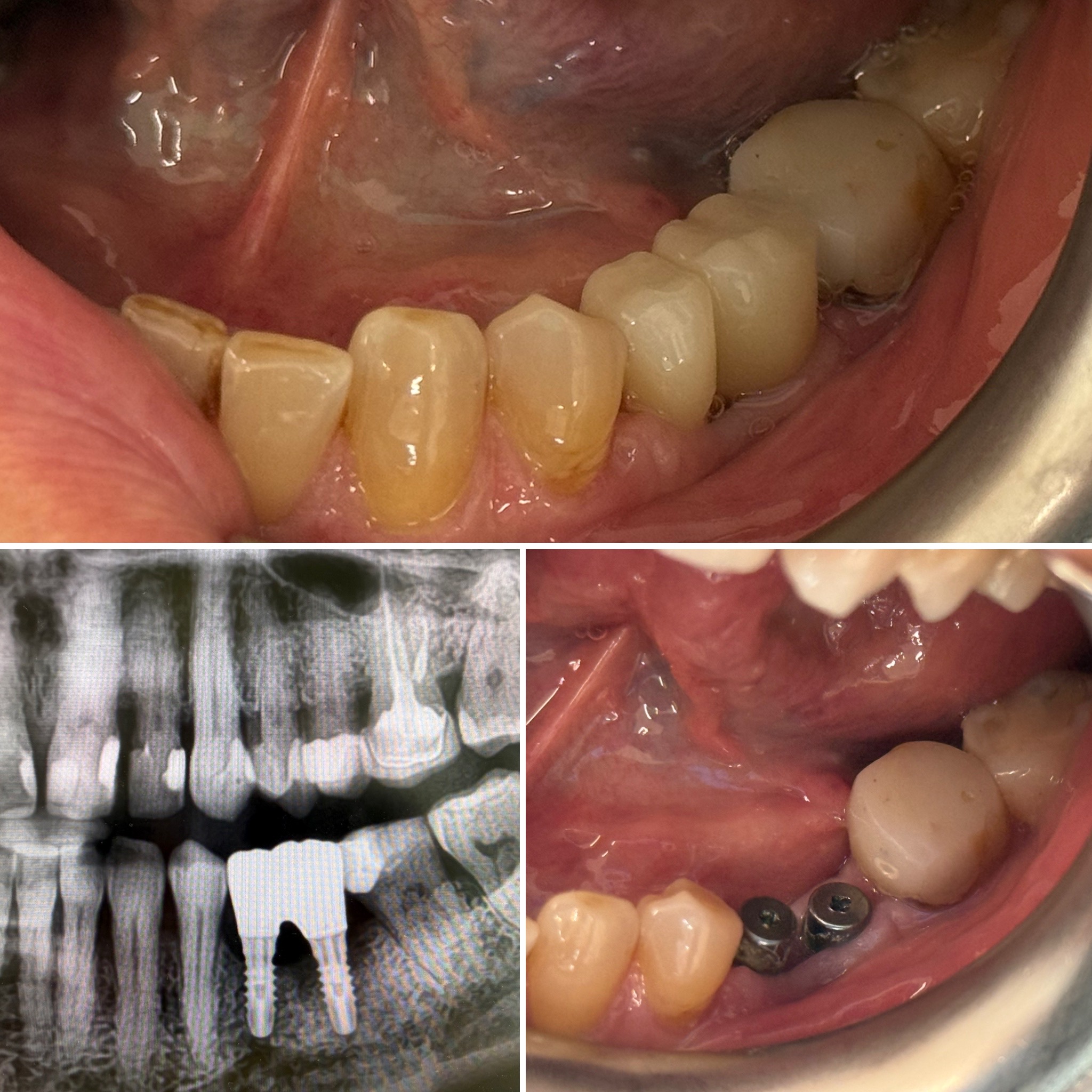 Korony cyrkonowe na implantach okolicy lewej dolnej 4 i 5