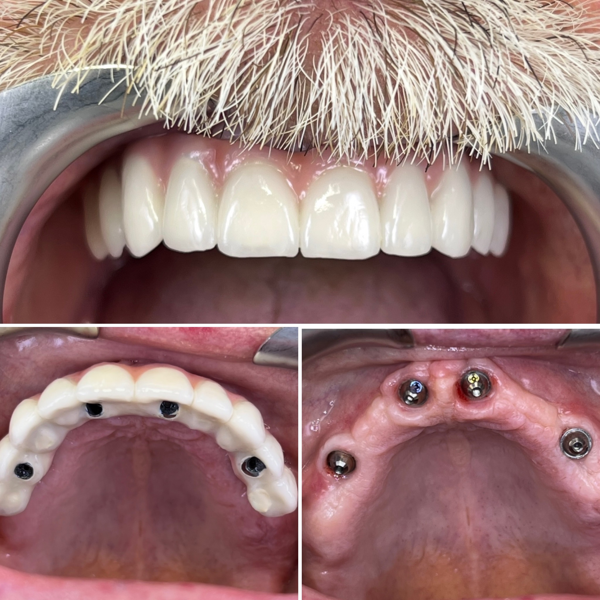 Most ceramiczno-metalowy na czterech implantach górnej szczęki