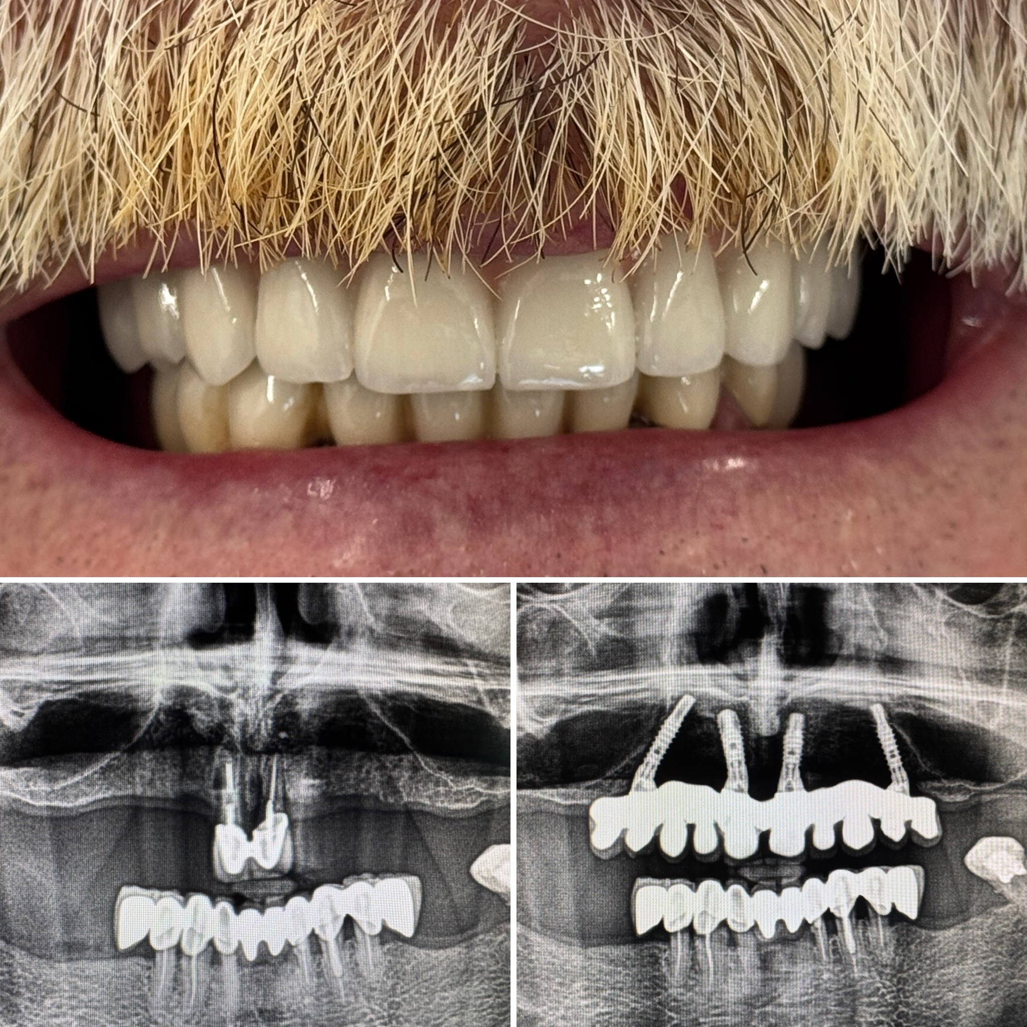 Most ceramiczny na czterech implantach górnego łuku