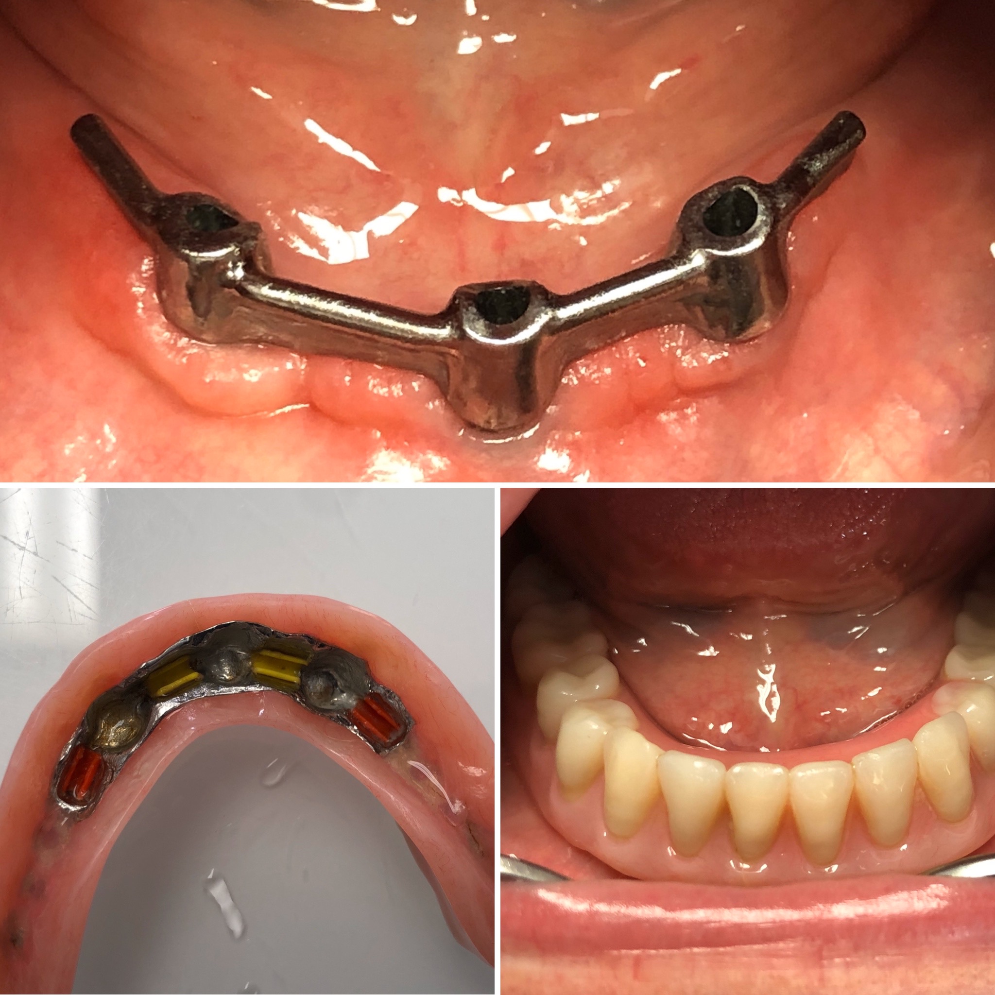 Proteza dolna na belce na 3 implantach