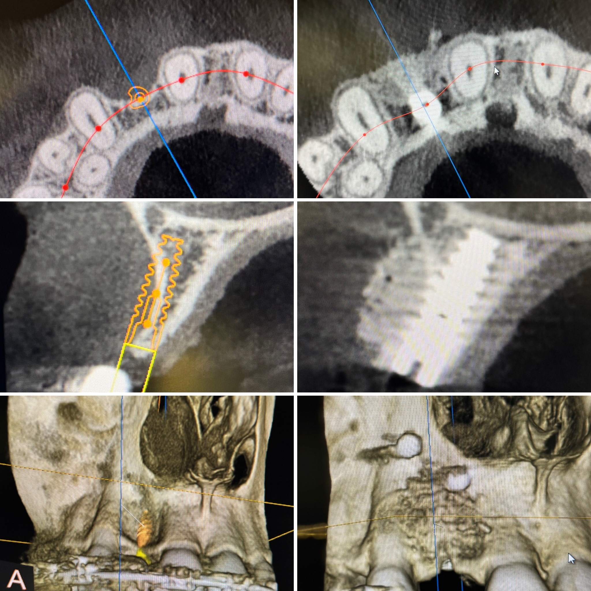 Wszczepienie implantu okolicy górnej prawej dwójki plus augmentacja kości